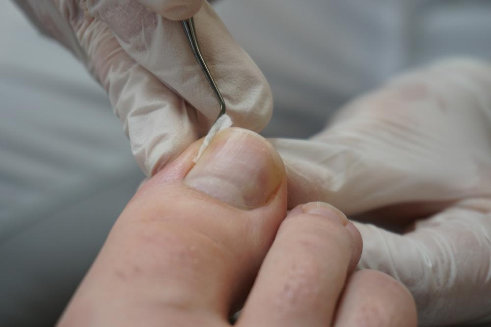 If your big toe is throbbing and hurts when you put on shoes or walk, you may have an ingrown toenail, which is a common con