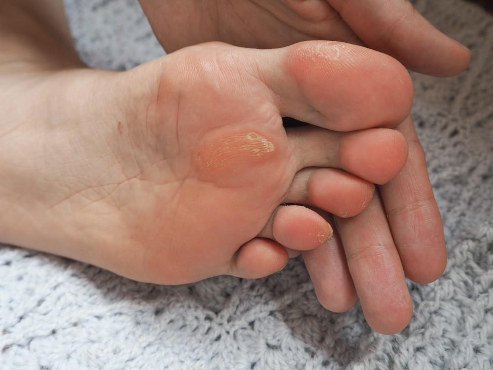 Are Calluses Serious?