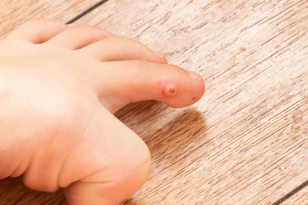5 Effective Treatments for Foot Warts