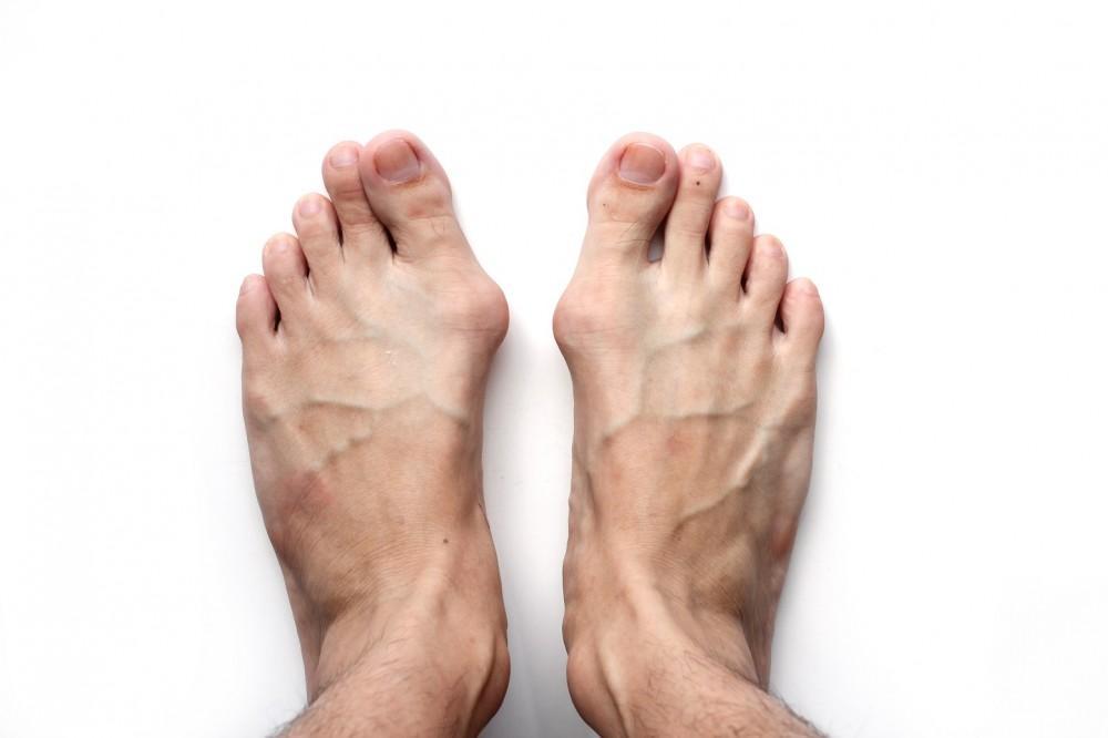 4 Effective Treatments for Painful Bunions