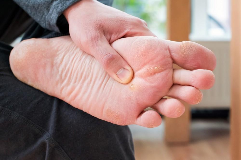 Can Plantar Warts Spread?