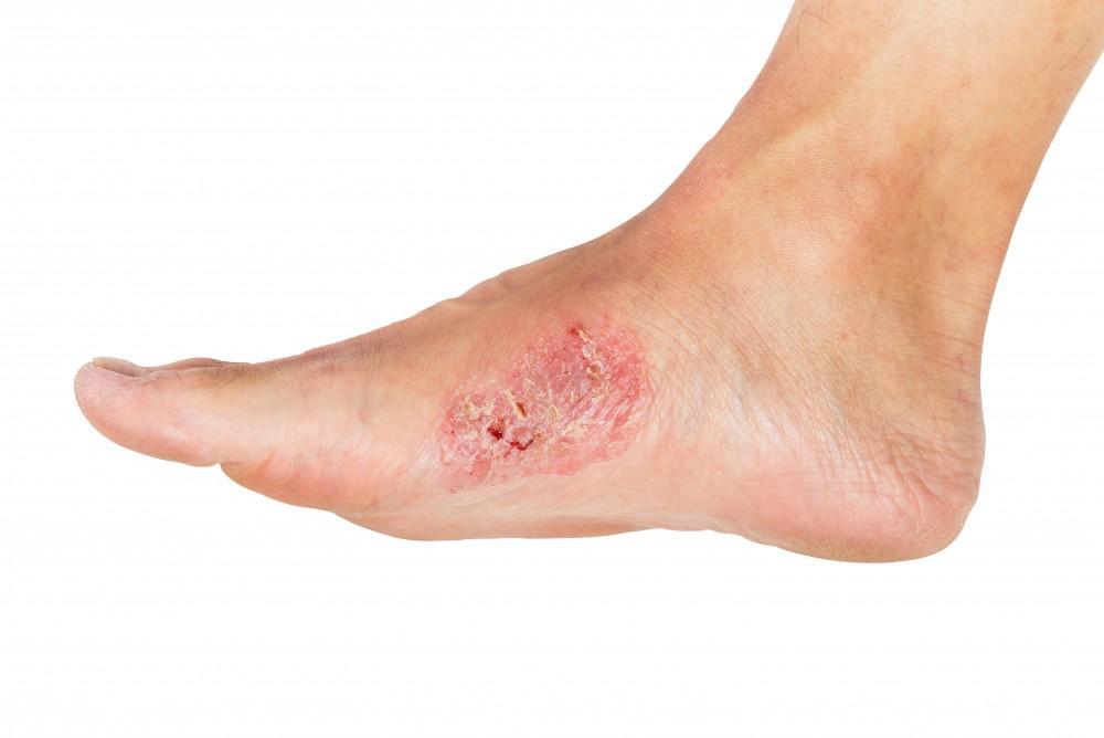 Blister