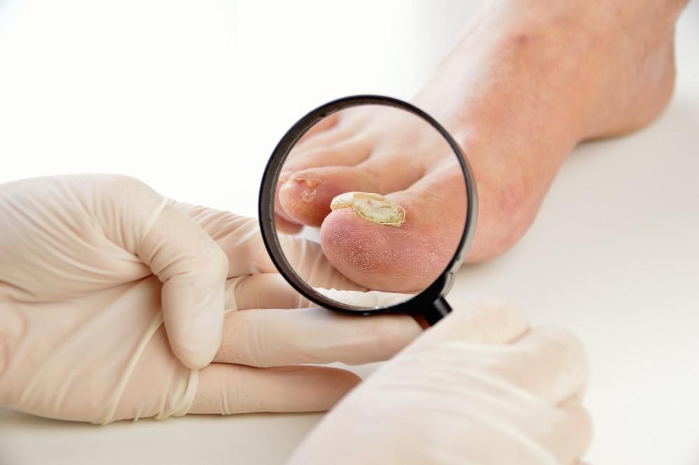 Is Nail Fungus Contagious?