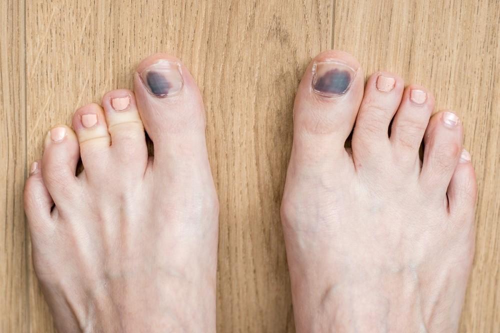 5 Ways to Prevent Runner's Toe 
