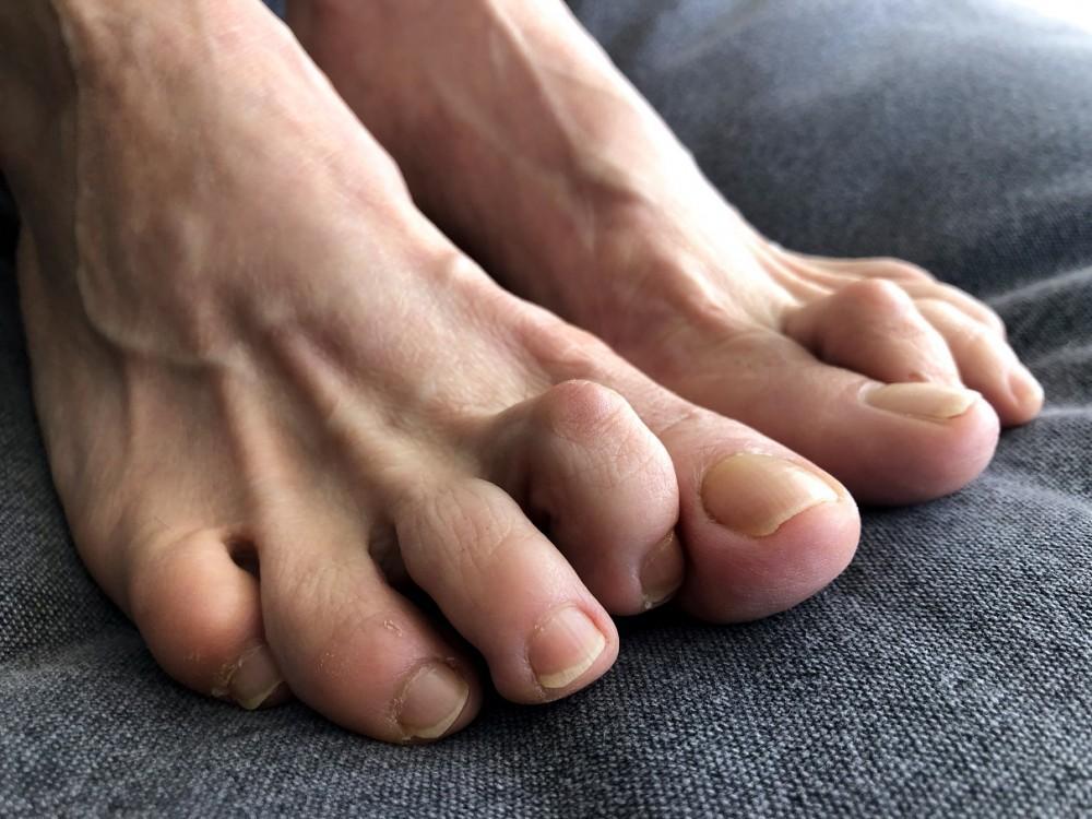 When to Consider Surgery for Your Hammertoe