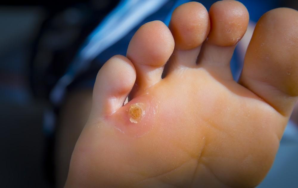 Tips for Preventing Corns and Calluses