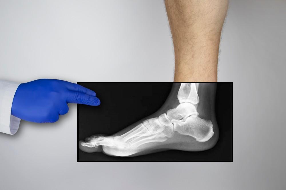 All About Stress Fractures: Causes, Symptoms, Treatment, and Prevention