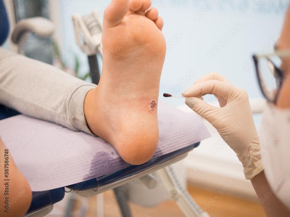 Are Plantar Warts Cause for Concern?