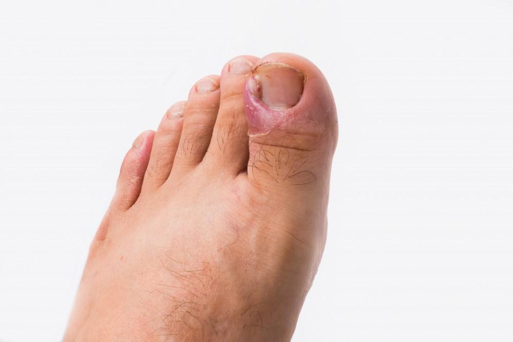 At-Home Care for an Ingrown Toenail — and When It Needs Expert Care