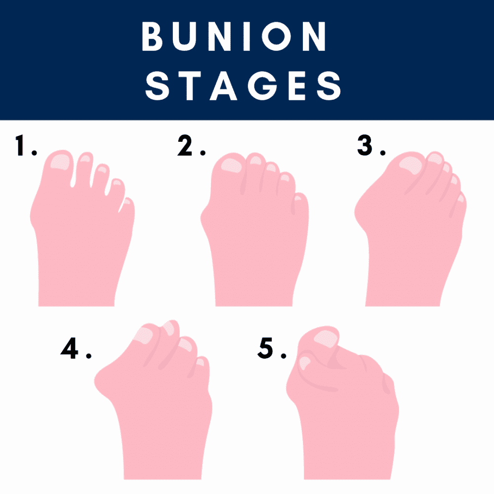 Stages of Bunion Progression